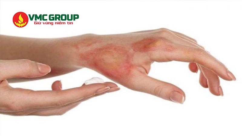 Oxy già có thể gây bỏng da nếu dùng nồng độ cao